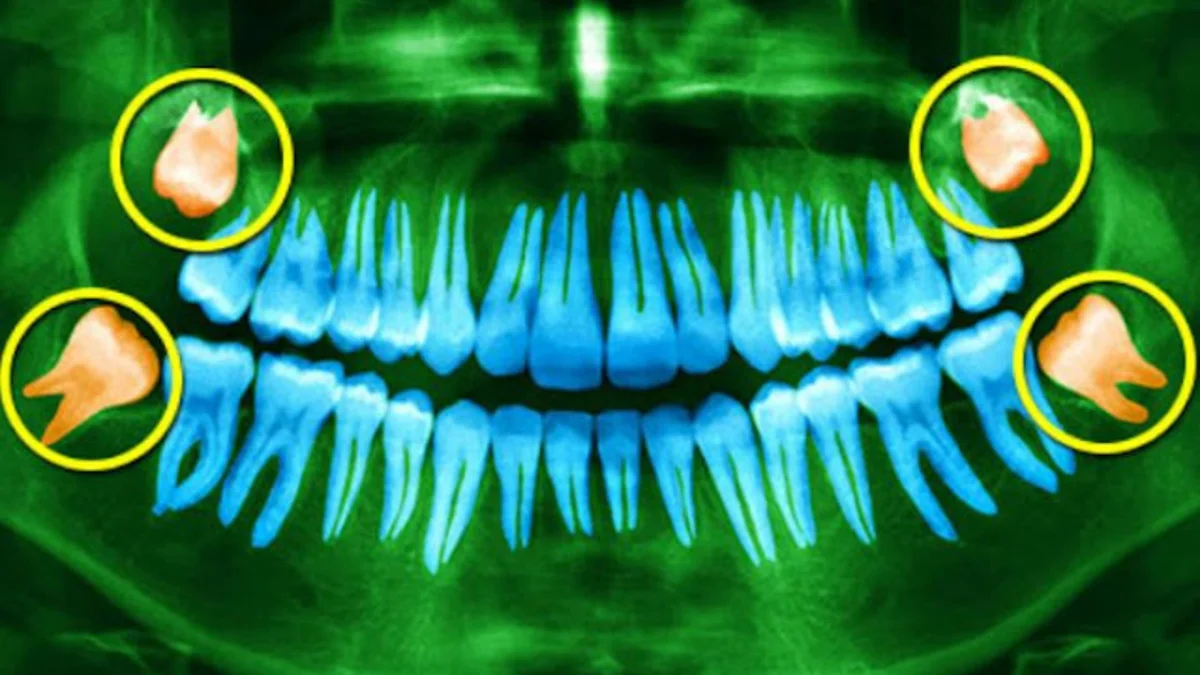 wisdom-tooth