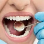 Home Remedies For Tooth Cavity: