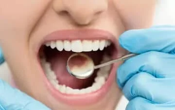 Home Remedies For Tooth Cavity: