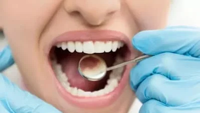 Home Remedies For Tooth Cavity: